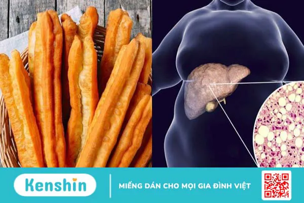 1 cái bánh quẩy bao nhiêu calo? Ăn bánh quẩy có gây béo không?