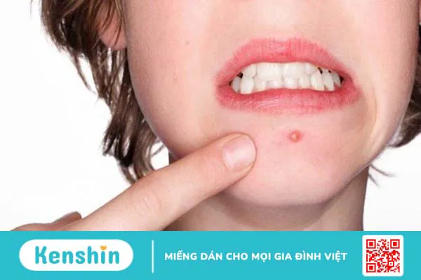 1 gói mì bao nhiêu calo? Ăn mì gói có mập không? Lưu ý khi ăn