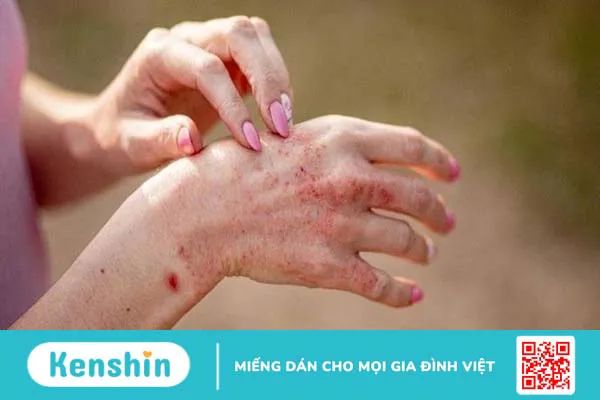 10 bệnh da liễu thường gặp và các biện pháp phòng ngừa hiệu quả