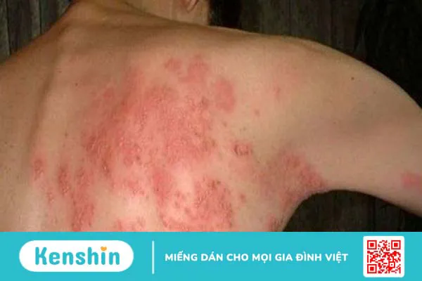 10 bệnh da liễu thường gặp và các biện pháp phòng ngừa hiệu quả