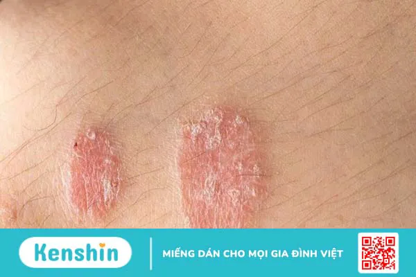 10 bệnh da liễu thường gặp và các biện pháp phòng ngừa hiệu quả