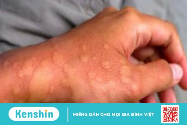 10 bệnh da liễu thường gặp và các biện pháp phòng ngừa hiệu quả