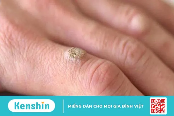 10 bệnh da liễu thường gặp và các biện pháp phòng ngừa hiệu quả