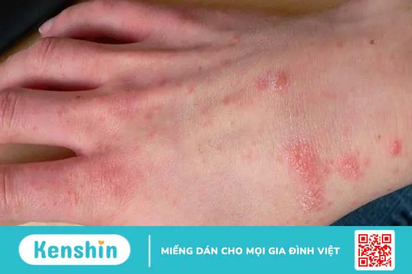 10 bệnh da liễu thường gặp và các biện pháp phòng ngừa hiệu quả