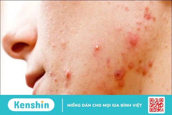 10 bệnh da liễu thường gặp và các biện pháp phòng ngừa hiệu quả