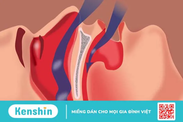 10 bệnh tai mũi họng thường gặp ở người lớn và trẻ em