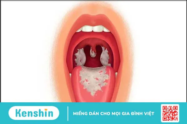 10 bệnh tai mũi họng thường gặp ở người lớn và trẻ em