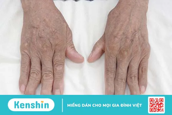 10 biến chứng viêm khớp dạng thấp bạn nên chú ý