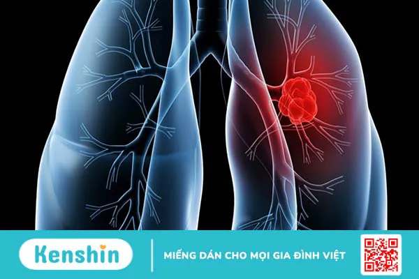 10 biến chứng viêm khớp dạng thấp bạn nên chú ý