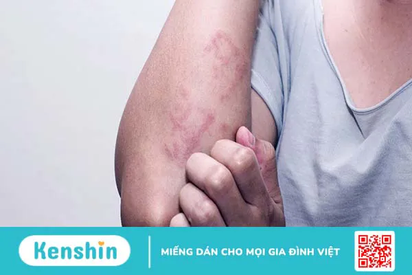 10 biến chứng viêm khớp dạng thấp bạn nên chú ý