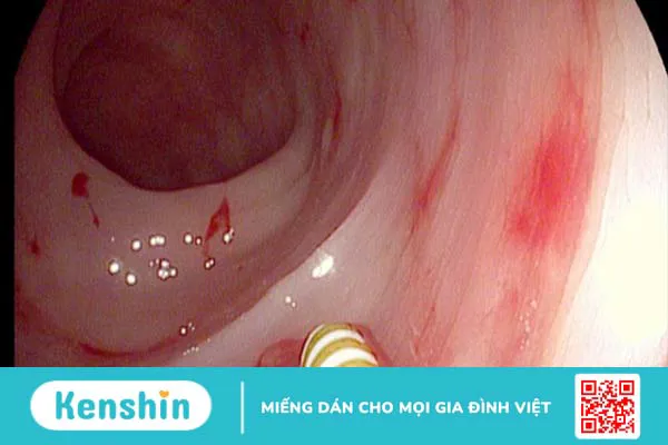 10 biến chứng xơ gan bạn không nên xem thường