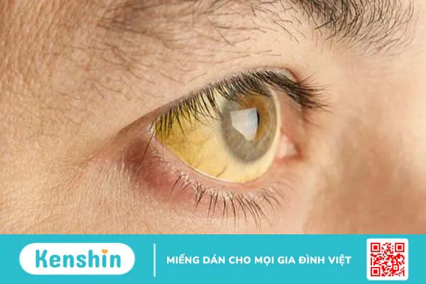 10 biến chứng xơ gan bạn không nên xem thường