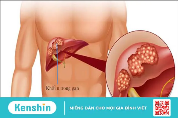 10 biến chứng xơ gan bạn không nên xem thường