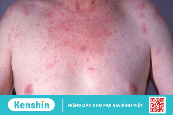 10 biến chứng xơ gan bạn không nên xem thường