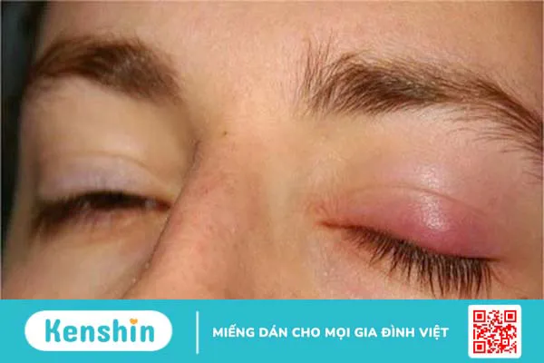 10 cách trị lẹo mắt NHANH NHẤT trong 1 đêm đơn giản hiệu quả