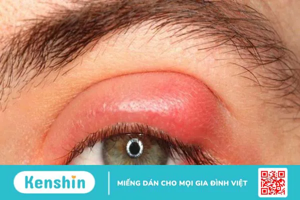 10 cách trị lẹo mắt NHANH NHẤT trong 1 đêm đơn giản hiệu quả