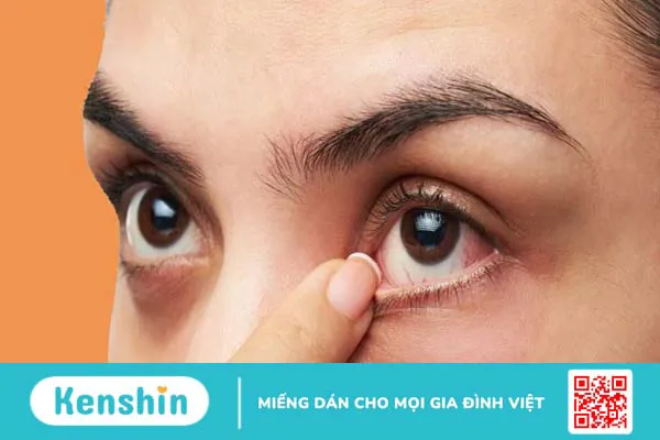 10 cách trị lẹo mắt NHANH NHẤT trong 1 đêm đơn giản hiệu quả