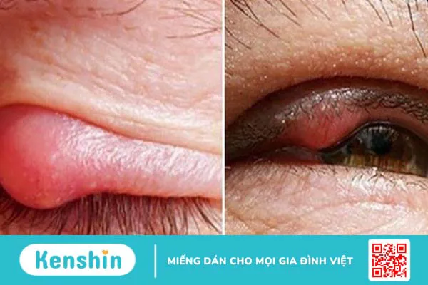 10 cách trị lẹo mắt NHANH NHẤT trong 1 đêm đơn giản hiệu quả