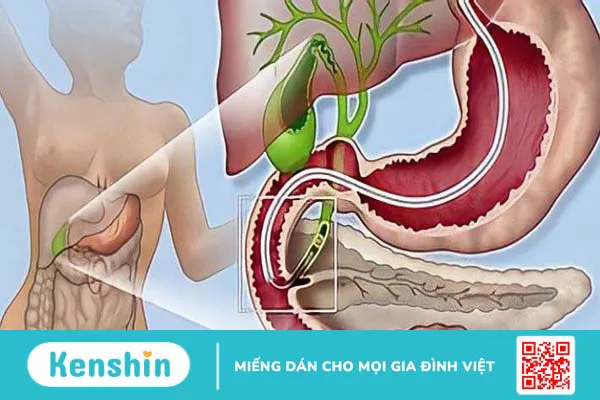 10 cách trị sỏi mật tại nhà đơn giản, hiệu quả bạn nên biết