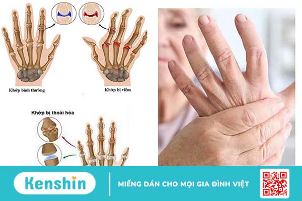 10 công dụng tuyệt vời của rau càng cua đối với sức khỏe