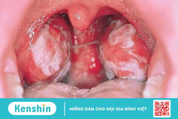 10 nguyên nhân dẫn đến bệnh amidan có thể bạn chưa biết