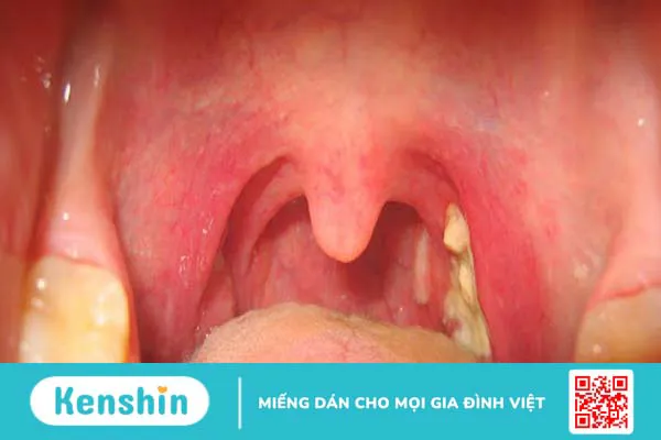 10 nguyên nhân dẫn đến bệnh amidan có thể bạn chưa biết