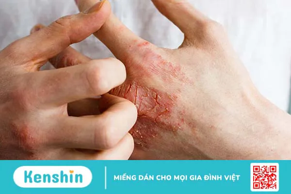 10 nguyên nhân dẫn đến bệnh amidan có thể bạn chưa biết