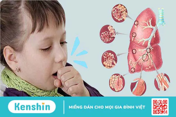 10 nguyên nhân dẫn đến bệnh amidan có thể bạn chưa biết