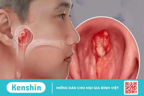 10 nguyên nhân gây chảy máu cam thường gặp