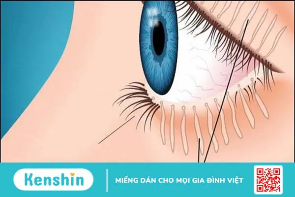 10 nguyên nhân gây ngứa mắt và cách làm dịu cơn ngứa nhanh chóng