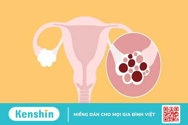 10 nguyên nhân rối loạn kinh nguyệt phái nữ cần biết