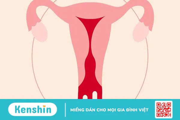 10 nguyên nhân rối loạn kinh nguyệt phái nữ cần biết