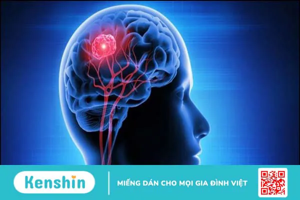 10 nguyên nhân rối loạn tiền đình phổ biến bạn nên lưu ý