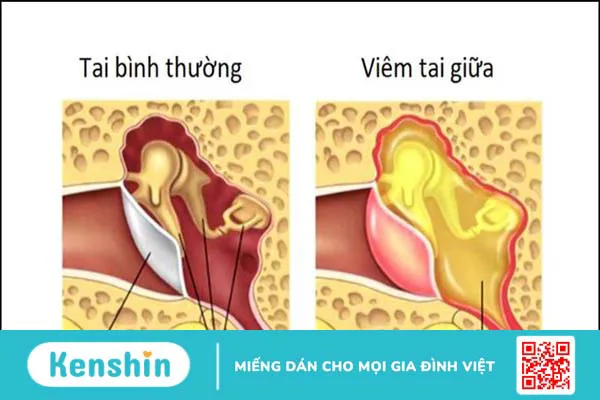 10 nguyên nhân rối loạn tiền đình phổ biến bạn nên lưu ý