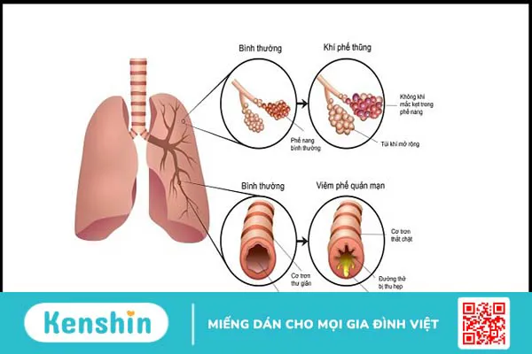 10 nguyên nhân viêm phế quản mà bạn cần chú ý