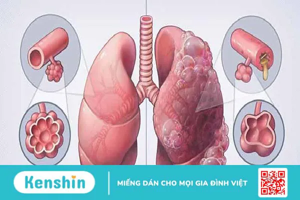 10 nguyên nhân viêm phế quản mà bạn cần chú ý