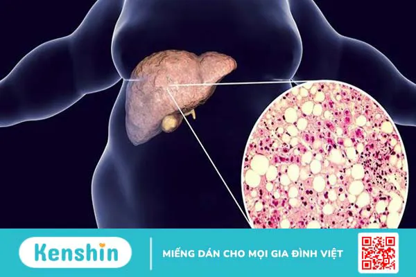 10 phương pháp tầm soát ung thư gan? Ai nên tầm soát sớm?