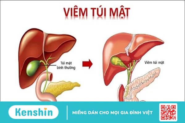 10 tác hại của ớt đối với sức khỏe – Ai không nên ăn ớt cần lưu ý ngay!