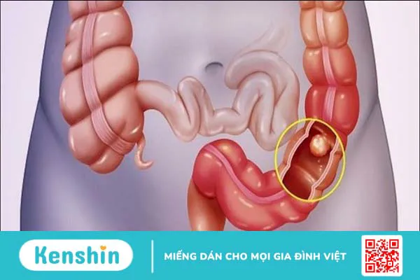 11 bệnh về máu thường gặp, nguyên nhân và cách phòng ngừa