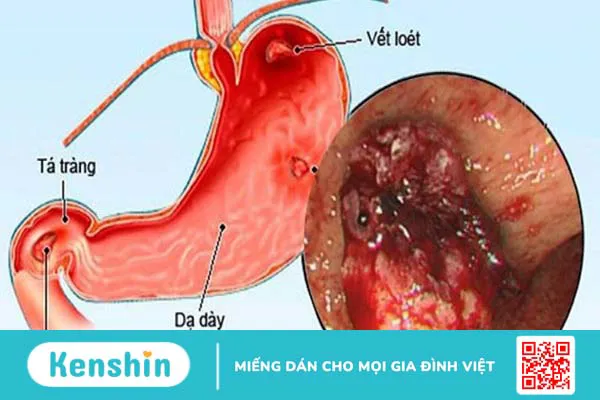 11 cách hết buồn nôn khi say rượu hiệu quả vào dịp tết và các lưu ý