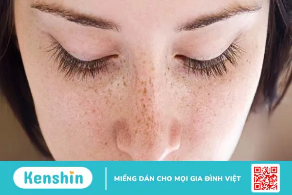 11 cách trị tàn nhang bằng lá tía tô đơn giản và hiệu quả tại nhà