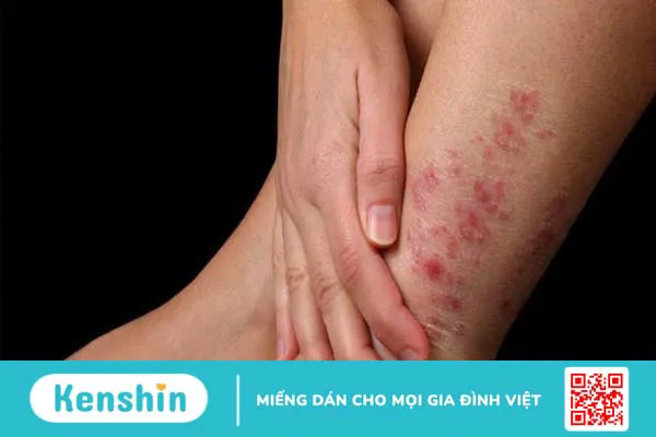 11 nguyên nhân gây ung thư da bạn không nên xem thường