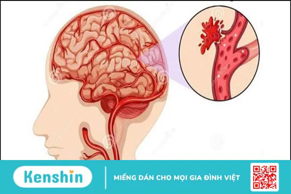 11 tác dụng phụ của aspirin và lưu ý khi sử dụng thuốc an toàn