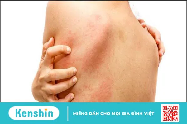 11 tác dụng phụ của aspirin và lưu ý khi sử dụng thuốc an toàn