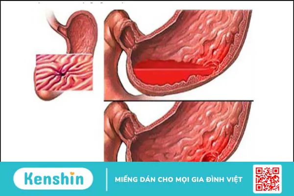 11 tác dụng phụ của aspirin và lưu ý khi sử dụng thuốc an toàn