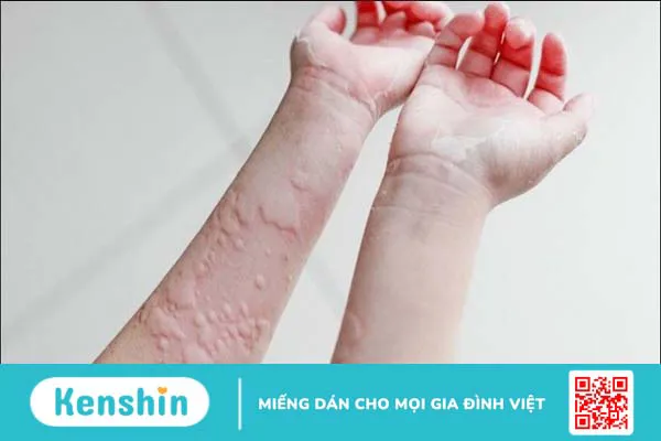 11 tác dụng phụ của aspirin và lưu ý khi sử dụng thuốc an toàn