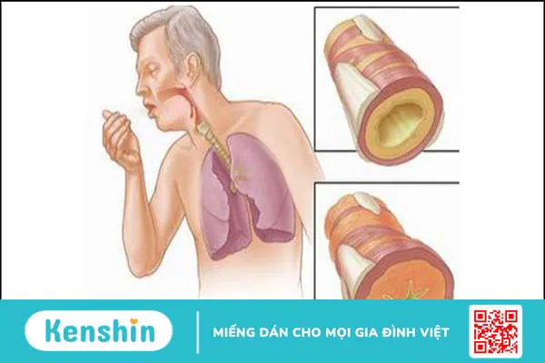 11 tác dụng phụ của aspirin và lưu ý khi sử dụng thuốc an toàn