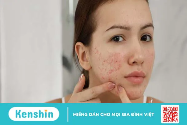 11 thói quen gây mụn các nàng nên tránh để có làn da khỏe đẹp