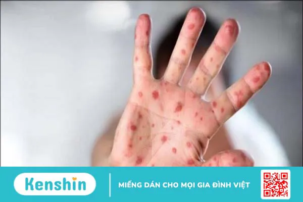 12 bệnh giao mùa thu đông thường gặp ở trẻ và cách phòng ngừa hiệu quả