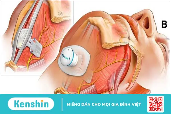 12 cách chữa chứng ngưng thở khi ngủ đơn giản và lưu ý bạn cần biết